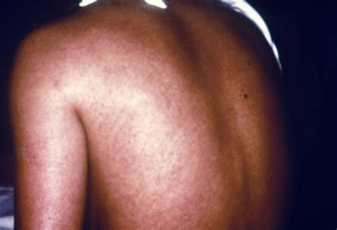 Early signs and symptoms include: Marburg Virus Pictures : Skin Rash 4 (Hardin MD / CDC)
