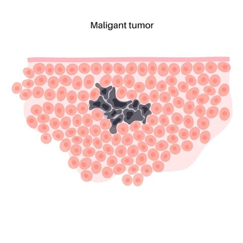 Premium Vector Vector Isolated Illustration Of Malignant Tumor In