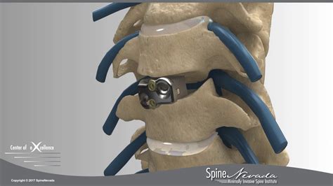 Anterior Cervical Discectomy And Fusion Acdf With Cage
