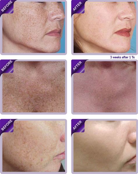 Ipl Skin Treatment Photofacials And Rejuventation Westminster Co