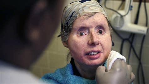 Chimp Victim Charla Nash Returns To Hospital With Face Transplant Complications Herald Sun
