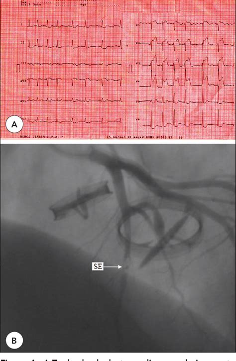 Figure From A Coronary Septic Embolism In Double Prosthetic Valve