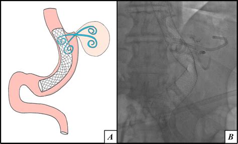 Diagram Of Combined Covered Stent And Double Pigtail Stent Placement