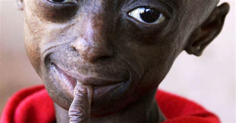 Progeria First Black Child With Rare Aging Disease Cbs News