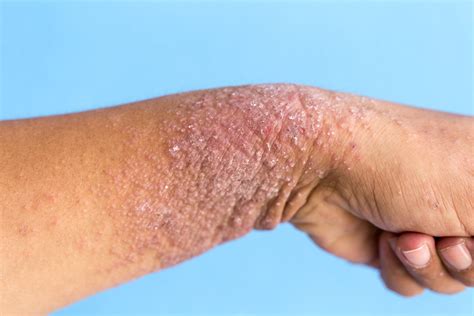Dermatite Atopique Comment La Reconna Tre Pour Mieux La Traiter