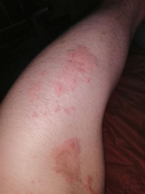 Eczema From Creatine Monohydrate After Taking 5g For 4 Weeks I Noticed