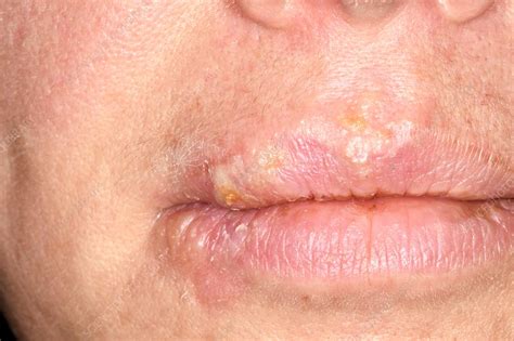 Cold Sores On Lips Stock Image C0382080 Science Photo Library
