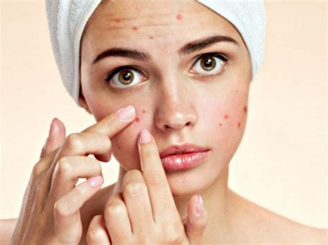 Take 5 Treatment Of Severe Acne • The Medical Republic