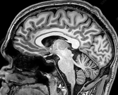 Normal Sagittal T1 Mri Brain 9 Stock Image C0393739 Science