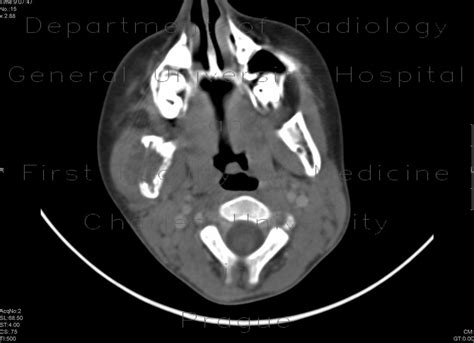 Radiology Case Eosinophilic Granuloma Of Mandible