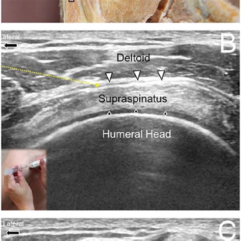 Subacromial Subdeltoid Bursa Injection Ultrasound Guided My Xxx Hot Girl