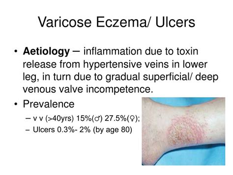 Ppt Varicose Eczema Ulcers Powerpoint Presentation Free Download