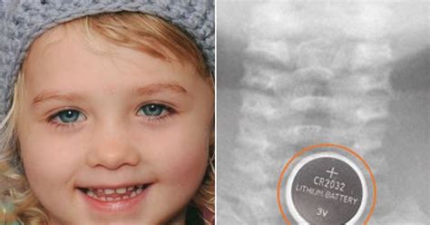 Girl 4 Who Dies After Swallowing Button Battery And Being Sent Home