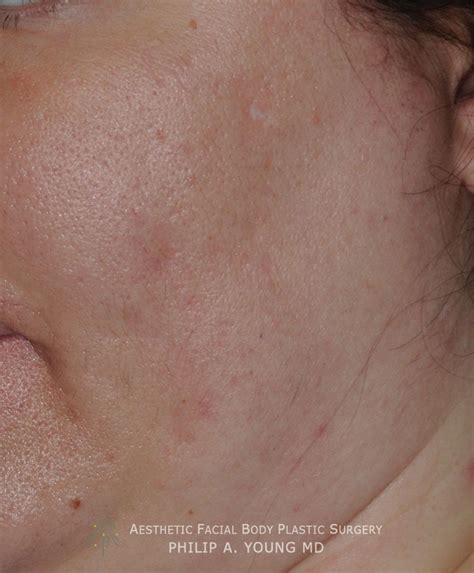 Acne Scar Treatment Before After Photos Seattle Bellevue