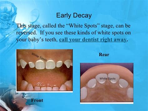 Pediatric Dentist Bangalore Process Of Dental Caries In Children