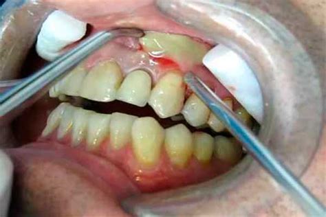 Conoce Los Síntomas Del Absceso Dental Blog Dentista En Tu Ciudad