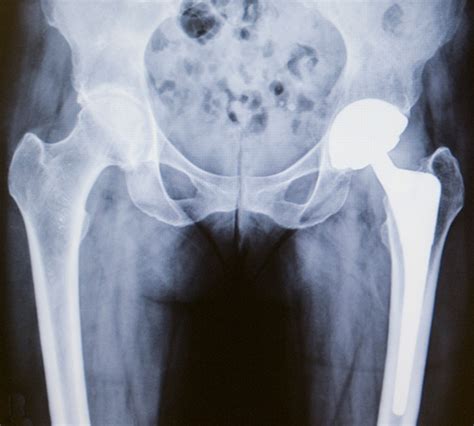 Hip Replacement Surgery Procedure Types And Risks Hss