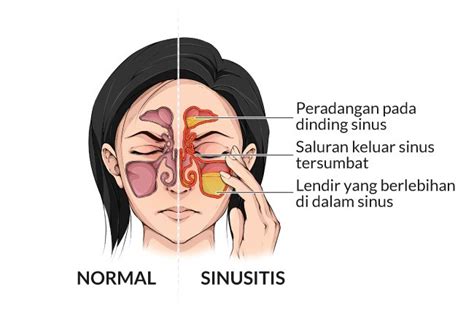 Jenis Jenis Sinusitis Yang Harus Anda Waspadai Klinik Arfa
