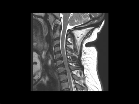 Cervical Microdiscectomy Via Posterior Foraminotomy Surgical Technique Orthoracle