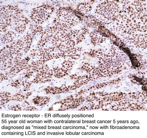 Pathology Outlines Lobular Carcinoma In Situ Lcis