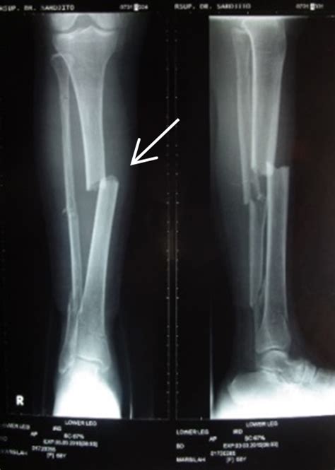 Orthopaedi Knowledges Management Of Long Bone Fractures