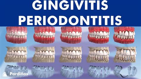 Gingivitis And Periodontitis Evolution © Youtube