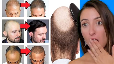 Involutional alopecia is a natural condition in which the hair gradually thins with age. Common Hair Loss Issues, Treatments, and Solutions - YouTube