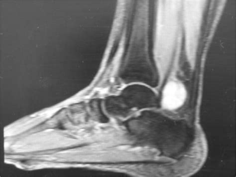 Tarsal Tunnel Syndrome Secondary To Schwannoma Of The Posterior Tibial