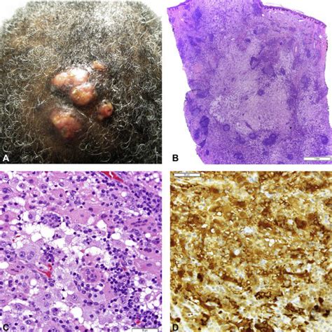 Cutaneous Rosai Dorfman Disease A The Clinical Manifestation On