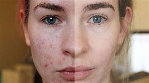 Coping With Acne Woman Video Blogs Skin Transformation BBC News