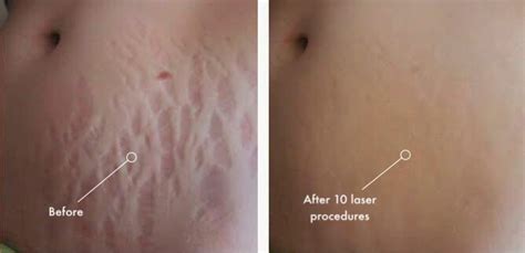 The Best Stretch Marks Removal Laser Treatment In Chennai Tamil Nadu Stretch Marks Are A Fact