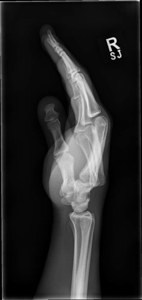 4th And 5th Carpometacarpal Joint Dislocations Image