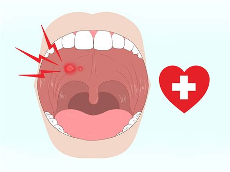 3 ways to get rid of mouth blisters wiki how to english