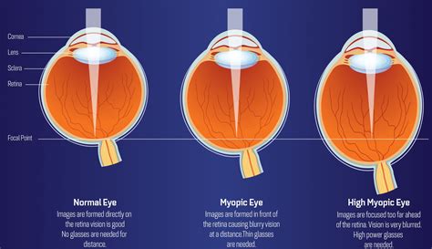 High Myopia Short Sightedness Dr Rehman Siddiqui