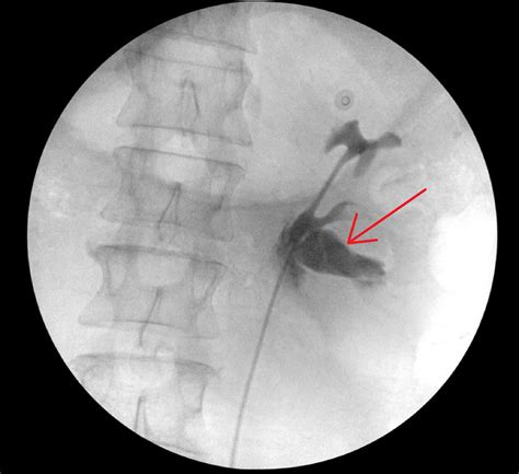 Cureus Two Cases Of Isolated Ureteral Injury Secondary To Blunt Force Trauma