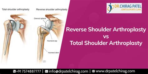 Shoulder Arthroplasty Total Vs Reverse Difference