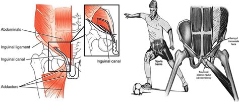 Sports Hernia Core Muscle Injury