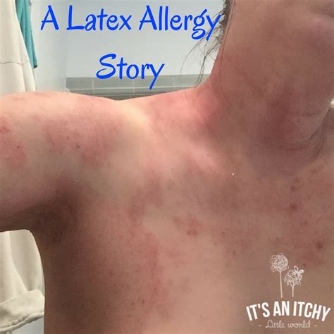 One Womans Incredible Story Of A Chronic Allergic Reaction To Latex