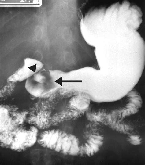 Imaging And Findings Of Lipomas Of The Gastrointestinal Tract Ajr