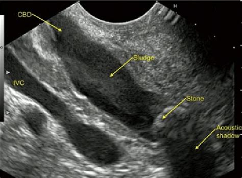 Common Bile Duct Stone Ultrasound