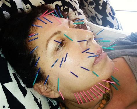 acupuncture face lift in kansas city facelift info prices photos reviews qanda
