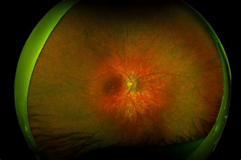 Retinitis Pigmentosa For Professionals Gene Vision