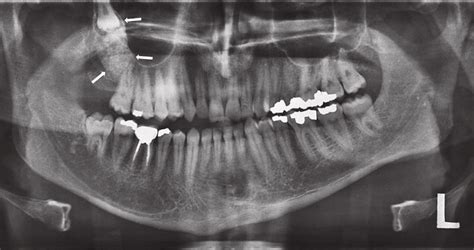 A Calcifying Odontogenic Cyst Associated With The Right Maxillary