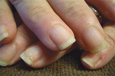 Ridges in fingernails are common and are usually a sign of aging, rodney says. Diagnosing Different Nail Types - Health - NAILS Magazine