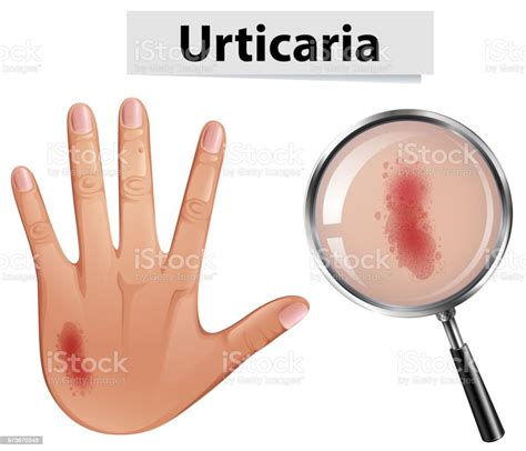 Urticaria Magnified On Hand Stock Illustration Download Image Now