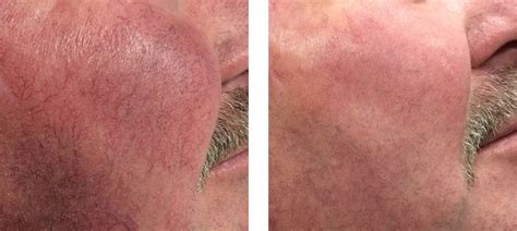 Facial Redness Treatment For Men Collins Cosmetic Clinic