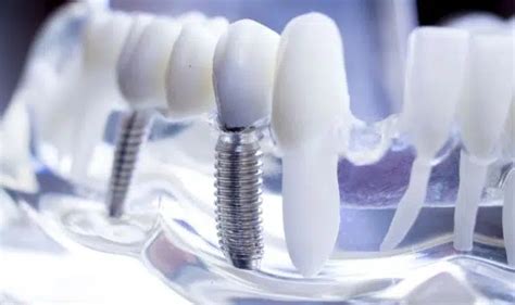 Assicurazione Dentistica Conviene Ecco I Costi E Le Migliori Online