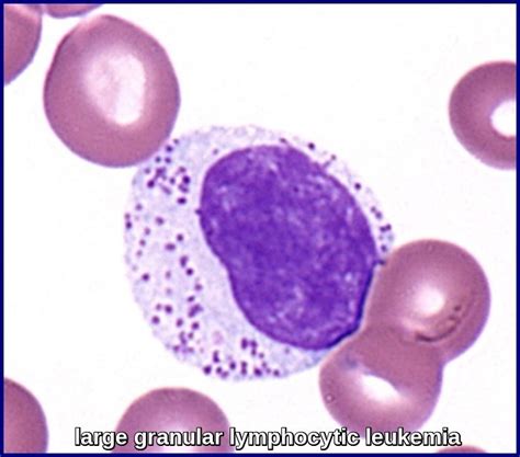 Large Granular Lymphocytic Leukemia Ask Hematologist Understand