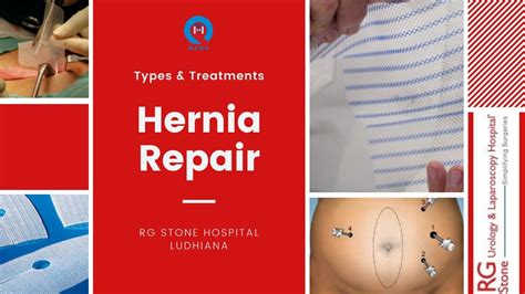 Hernia Repair Refers To A Surgical Operation For The Correction Of A