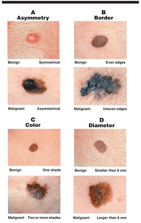 Characteristics Of Cancerous Moles Medizzy